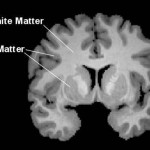 מחלות של החומר הלבן במוח